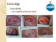 Colla-Algi: for severe and sizable pressure sore